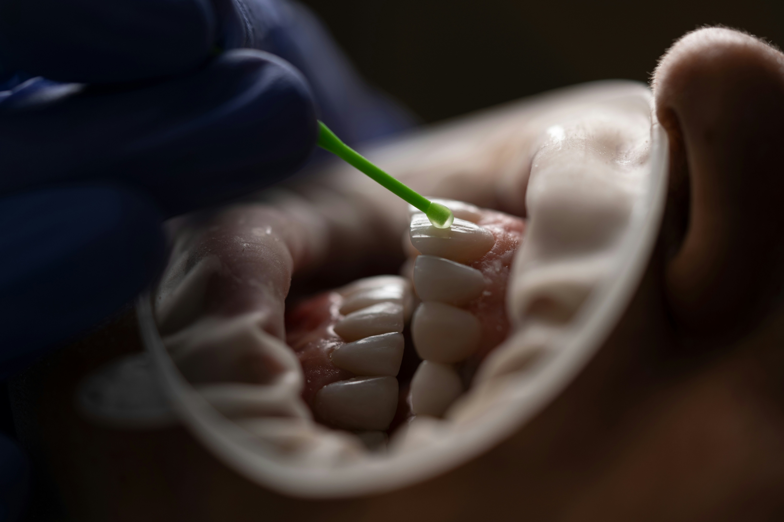 What is a Laminated Tooth Veneer? An Insightful Overview