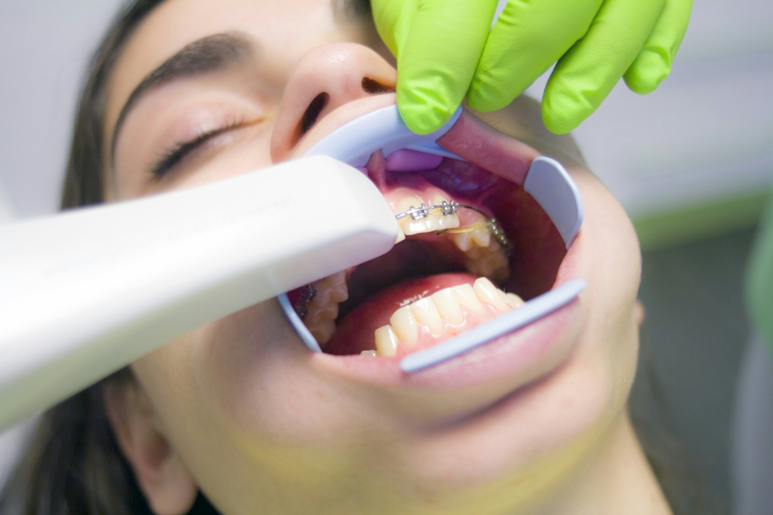 Achieving a Perfect Smile: Orthodontics and Braces in Alanya