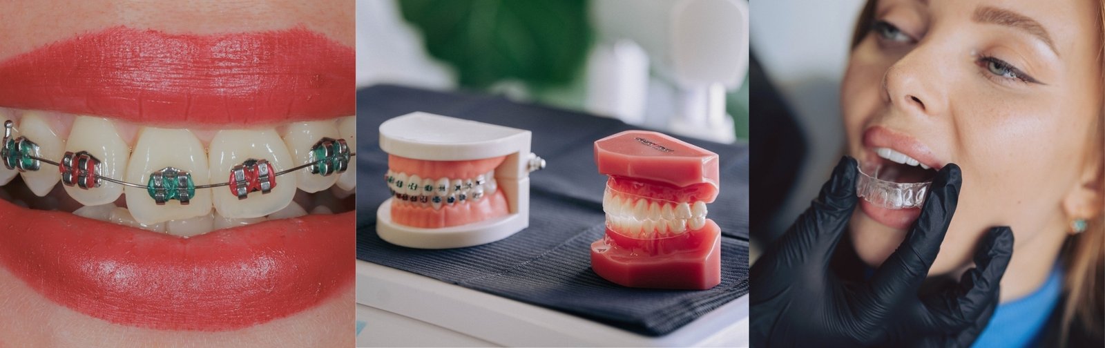 Orthodontics & Invisalign at OD Clinic