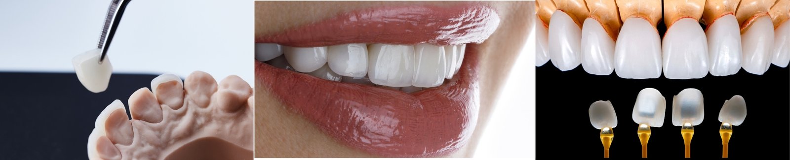 Veneer procedure OD Clinic