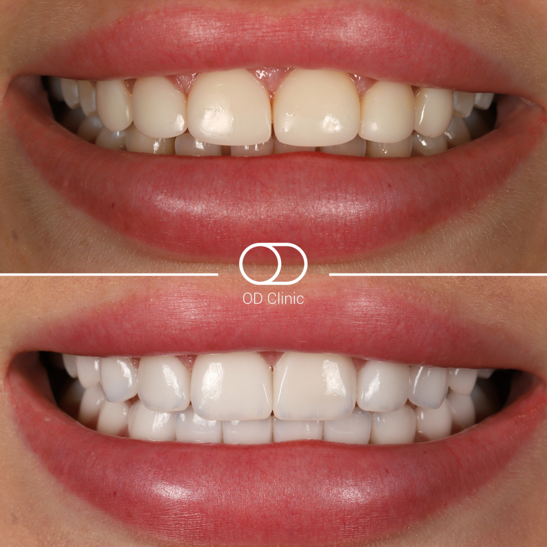 Crowns case — before & after