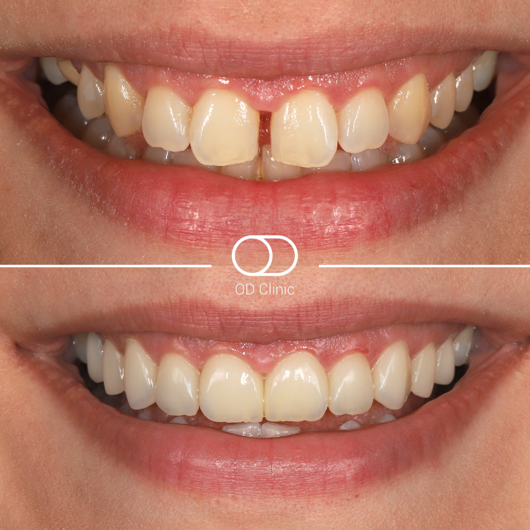Veneers case — before & after