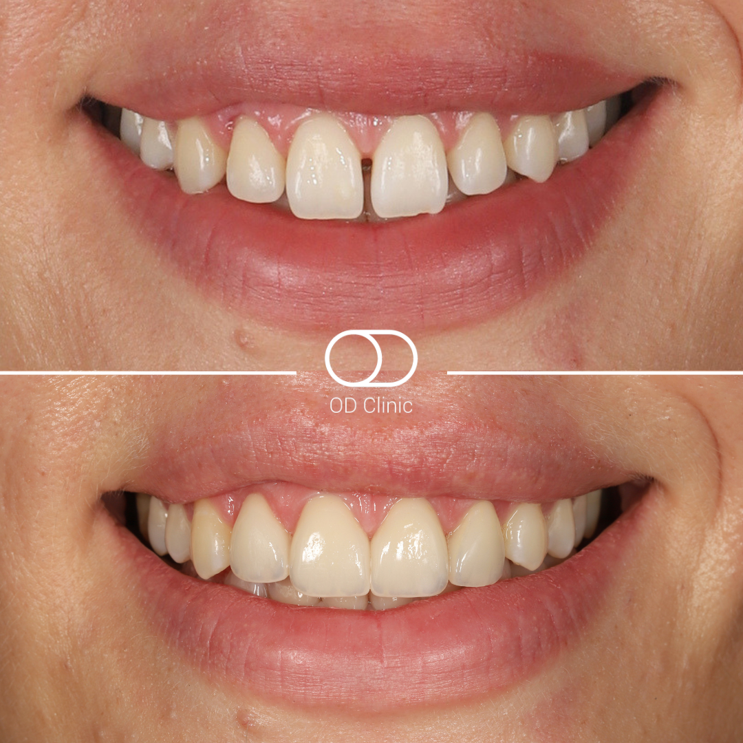 Veneers case — before & after