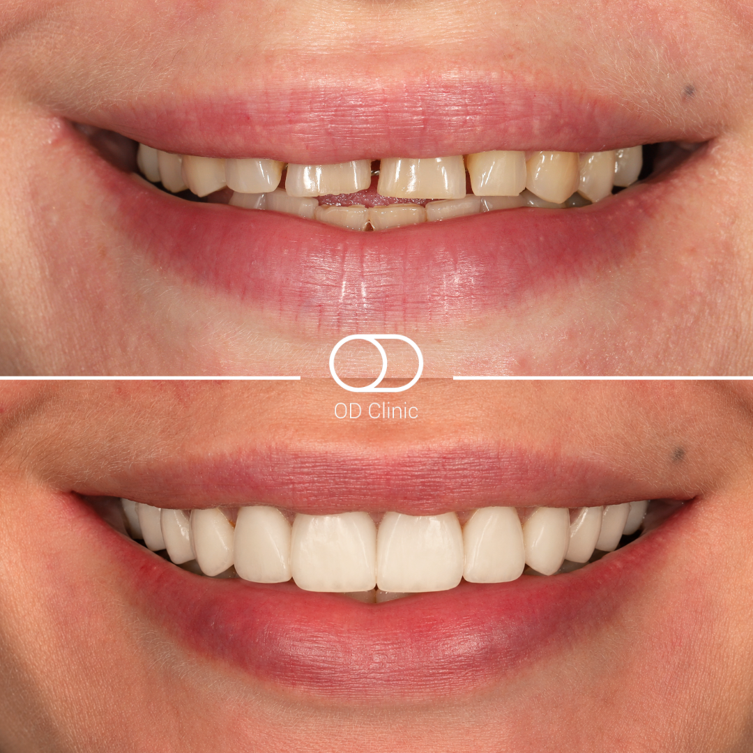 Crowns case — before & after