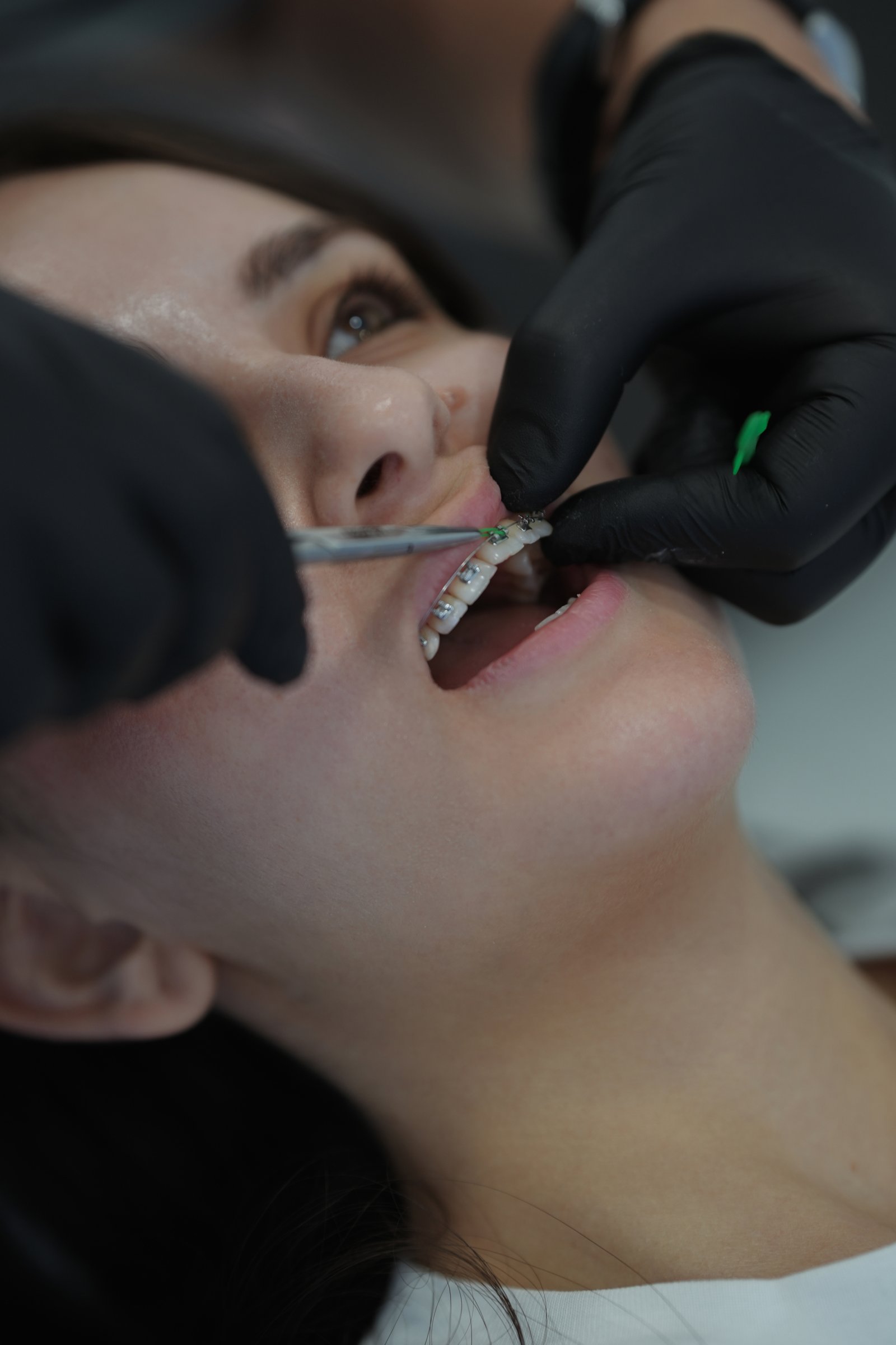 Dental Braces at OD Clinic Alanya